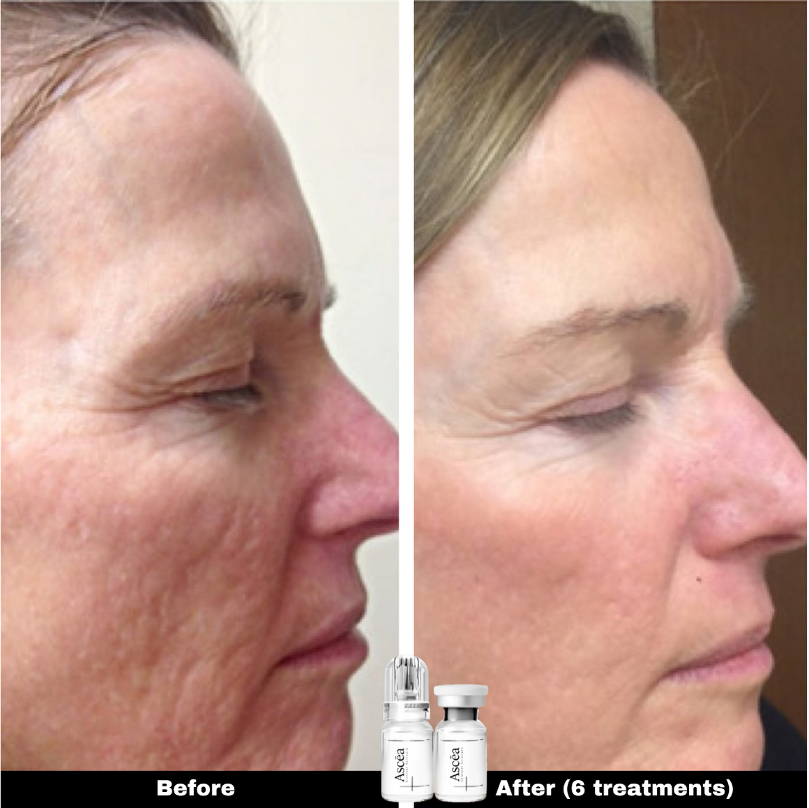 Micro-Infusion Facial System — Skincare That Goes Deeper