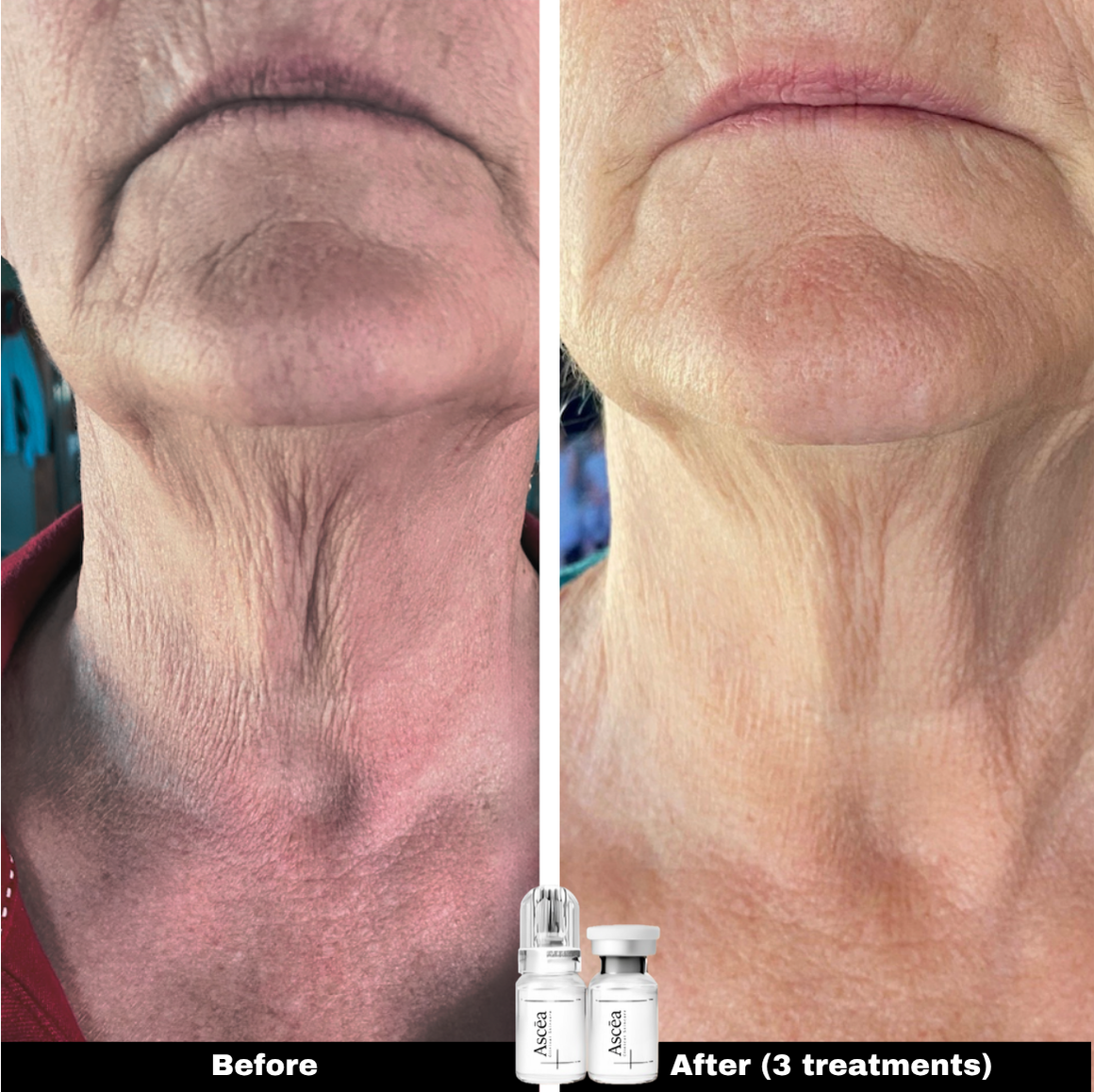 Micro-Infusion Facial System — Skincare That Goes Deeper