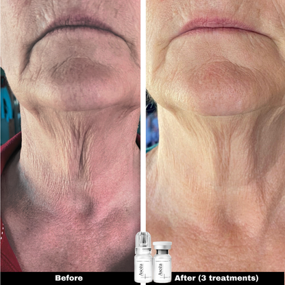 Micro-Infusion Facial System — Skincare That Goes Deeper