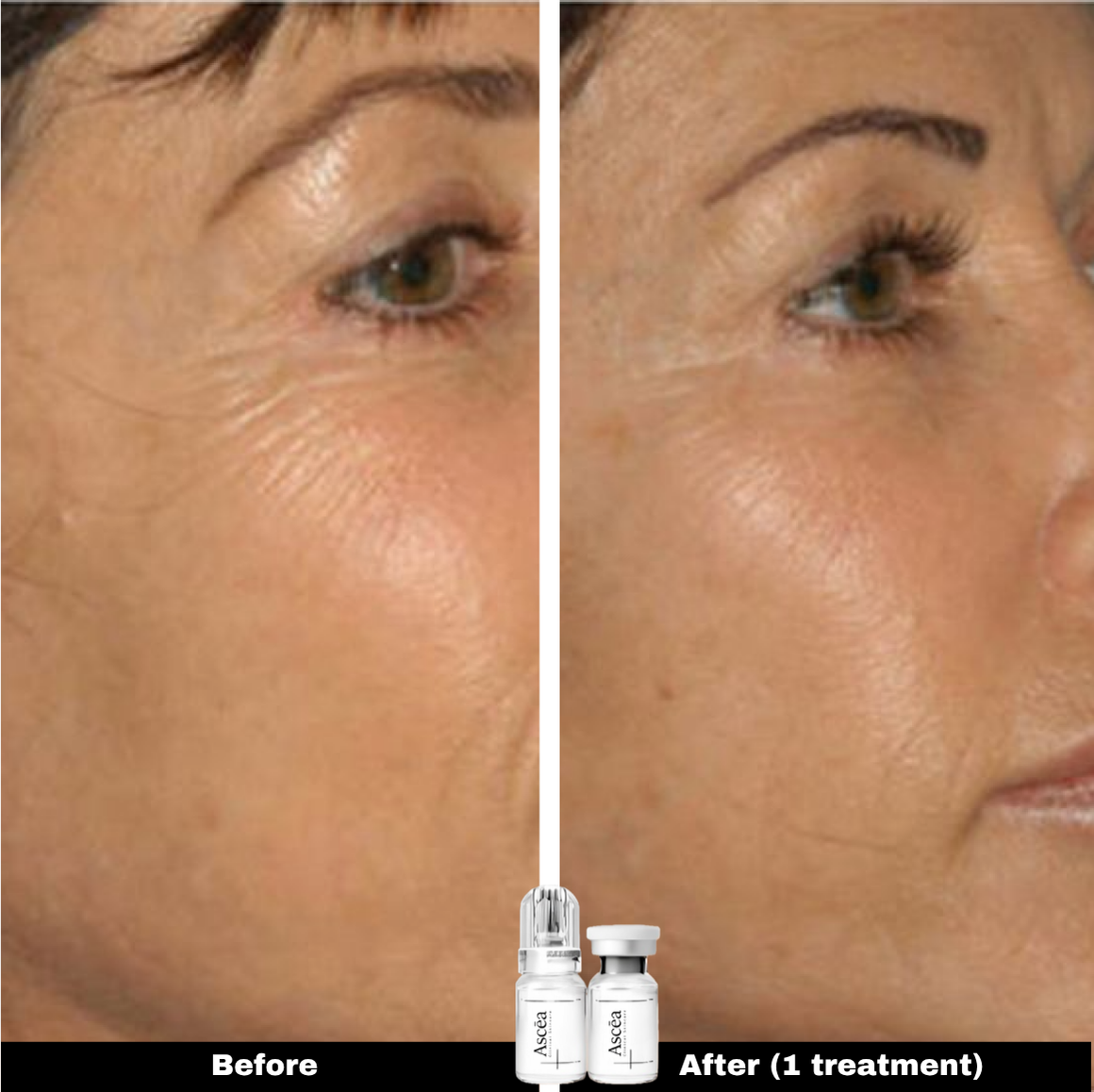Micro-Infusion Facial System — Skincare That Goes Deeper