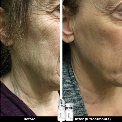 Micro-Infusion Facial System — Skincare That Goes Deeper