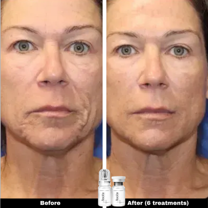 Micro-Infusion Facial System — Skincare That Goes Deeper