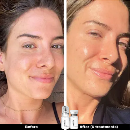 Micro-Infusion Facial System — Skincare That Goes Deeper