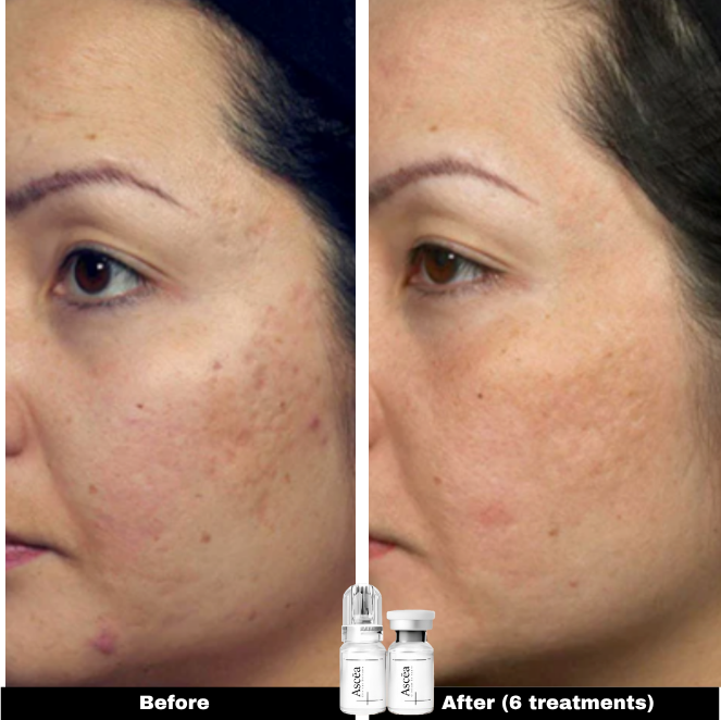 Micro-Infusion Facial System — Skincare That Goes Deeper