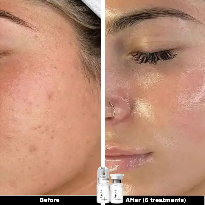 Micro-Infusion Facial System — Skincare That Goes Deeper