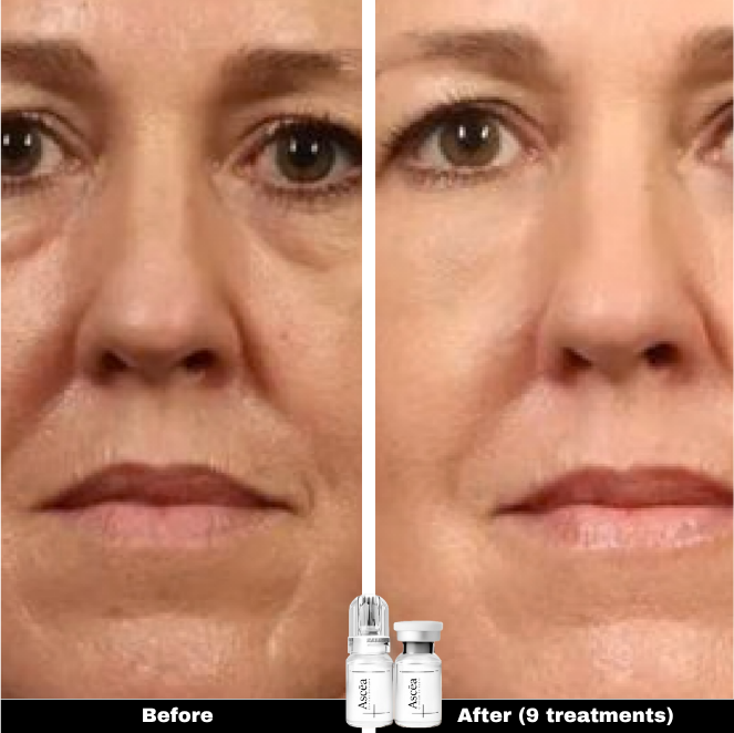Micro-Infusion Facial System — Skincare That Goes Deeper